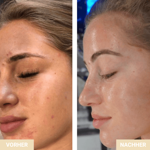 Vorher Nachher - Akne Behandlung