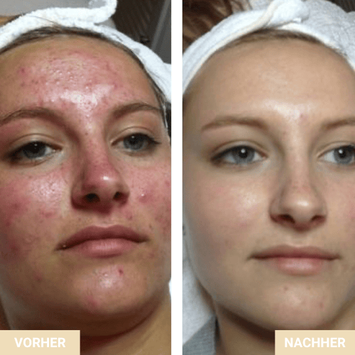 Vorher Nachher - Rötungen