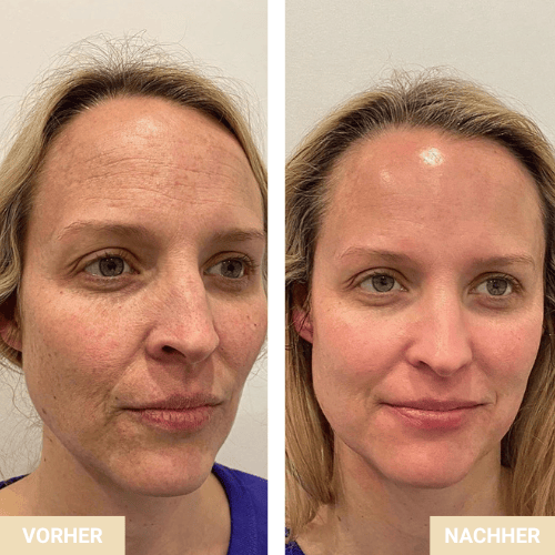 Vorher Nachher - Hautbild